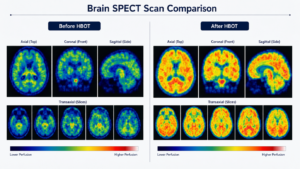 Hyperbaric Chamber for Autism and ADHD Real Res...